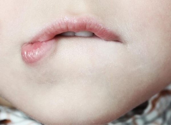 Les tics de léchage : votre enfant ne peut s’empêcher de se lécher les lèvres ?